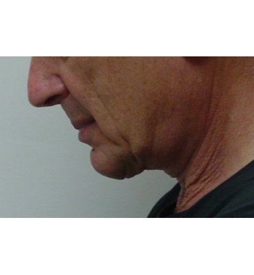 neck lift without scars